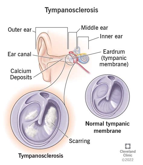 Increased Tympanic Membrane Flexibility Older Adults